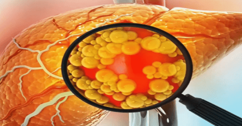 How to Check for Fatty Liver at Home: Tips from a Harvard-Trained Gastroenterologist